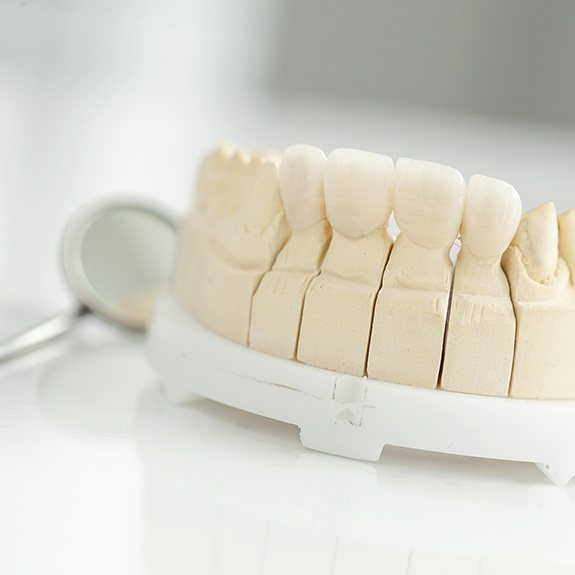 Model smile with metal-free dental restoration