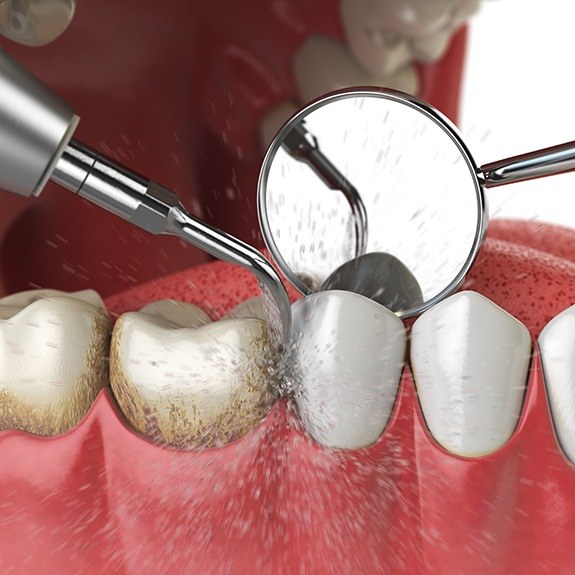 Animted periodontal maintenance treatment