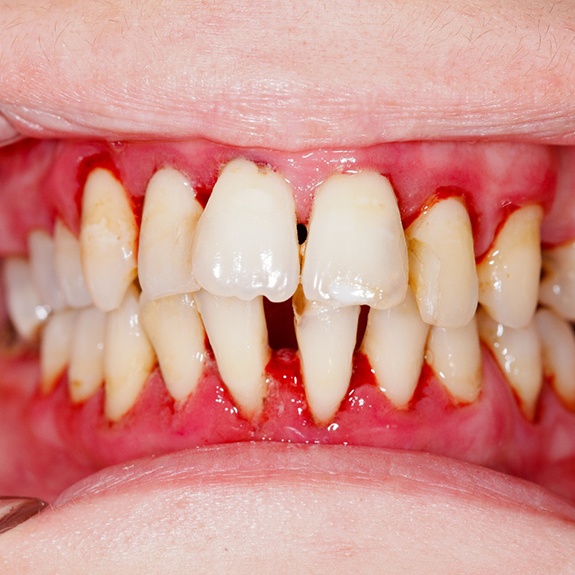 A patient with advanced gum disease.