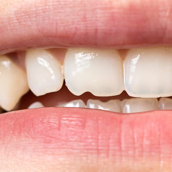 A closeup of a slightly chipped tooth