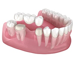 3D render of a dental bridge