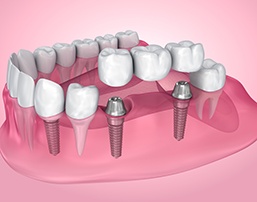 3D render of an implant bridge