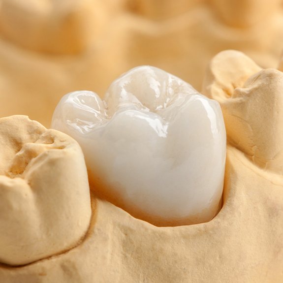 Model smile with dental crown restoration