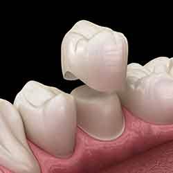 The materials used to make your dental crown can influence the cost. 