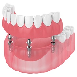 Digital illustration of implant dentures in Lancaster
