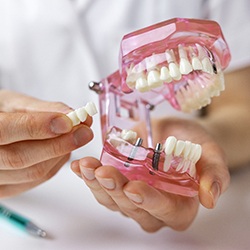 a model of an implant bridge