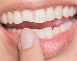 Smile with chipped and broken front tooth