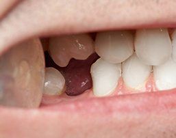 Smile with knocked out bottom tooth