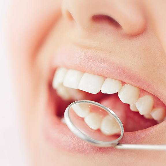 Closeup of tooth-colored fillings in Lancaster