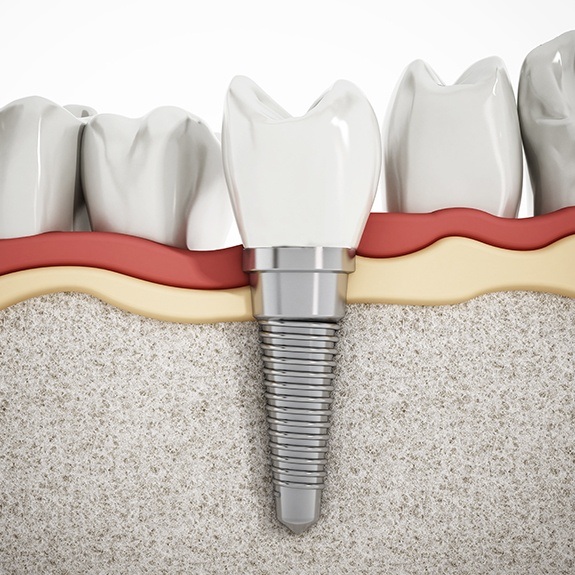 Animated implant spported replacement tooth