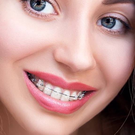 a woman smiling while wearing clear or ceramic braces 