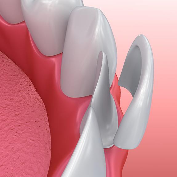 Illustration of veneers being attached to tooth