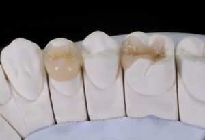 diagram of fillings and dental crowns