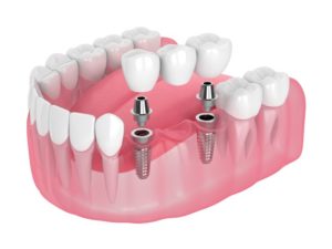 dental bridge of three teeth 3D illustration 