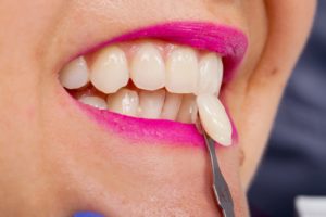 Woman at dentist for veneer replacement